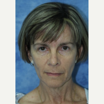 45-54 year old woman treated with Fat Transfer to face and neck lift before 3177840