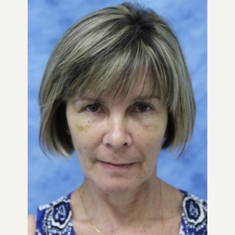 45-54 year old woman treated with Fat Transfer to face and neck lift after 3177840