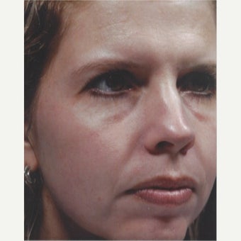 45-54 year old woman treated with Melasma Treatment with Obagi Nu Derm Skin Transformation System after 2581697