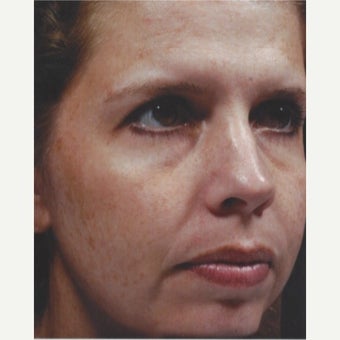 45-54 year old woman treated with Melasma Treatment with Obagi Nu Derm Skin Transformation System before 2581697