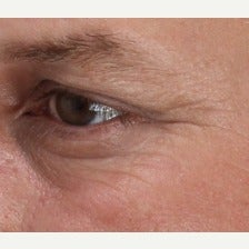 35-44 year old man treated with Belotero after 1804214