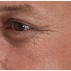 35-44 year old man treated with Belotero before 1804214