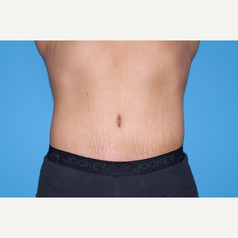 25-34 year old man treated with Body Lift after 3280621