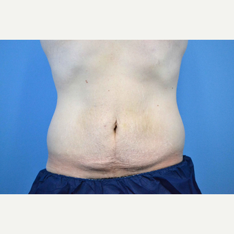 25-34 year old man treated with Body Lift before 3280621