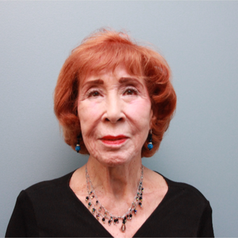 83 year old woman treated with the LiteLift® which is similar to the Quick Lift before 3544570
