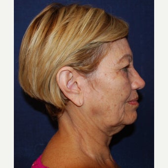 65-74 year old woman treated with Mini Lift before 2672135