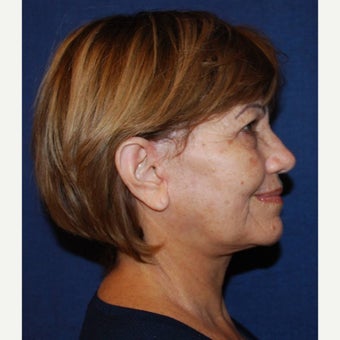 65-74 year old woman treated with Mini Lift after 2672135