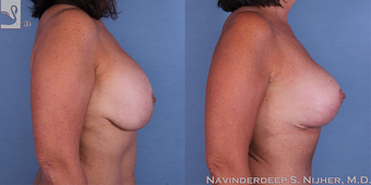 55-64 year old woman treated with Breast Lift with Implants after 3768739