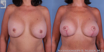 55-64 year old woman treated with Breast Lift with Implants before 3768739