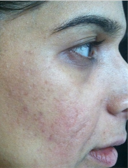35-44 year old woman treated with Acne Scars Treatment before 1680593
