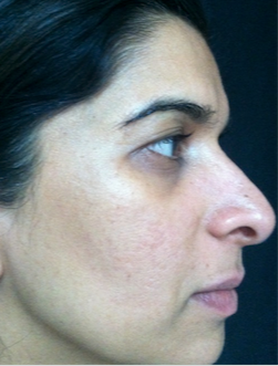 35-44 year old woman treated with Acne Scars Treatment after 1680593