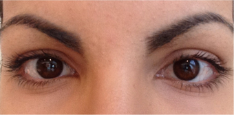 Female Latisse Results before 1165700