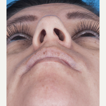 35-44 year old woman treated with Rhinoplasty before 3115234