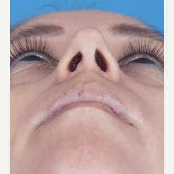 35-44 year old woman treated with Rhinoplasty after 3115234
