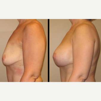 45-54 year old woman treated with Breast Lift with Implants after 2780729