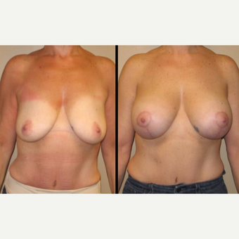 45-54 year old woman treated with Breast Lift with Implants before 2780729