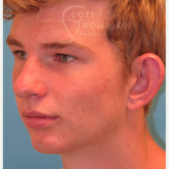 17 or under year old man treated with Ear Lobe Surgery before 3624993