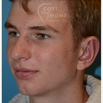 17 or under year old man treated with Ear Lobe Surgery after 3624993