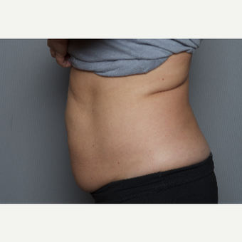 55-64 year old woman treated with SculpSure before 3584225