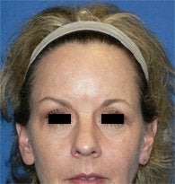 Endoscopic Browlift before 384694