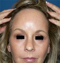 Endoscopic Browlift after 384694