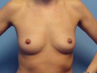Breast Augmentation before 986487
