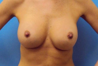 Breast Augmentation after 986487