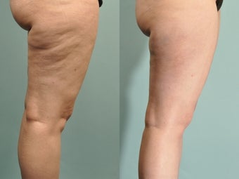 40 year old Cellulaze anterior and posterior thighs - 10 days post op before 1024159