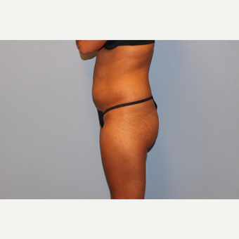 25-34 year old woman treated with Brazilian Butt Lift before 3565714