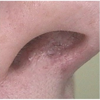 35-44 year old woman treated with Pulsed Dye Laser after 2119800
