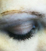 25-34 year old woman treated with Eyebrow Transplant before 3420857