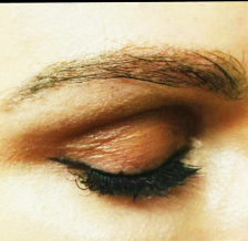25-34 year old woman treated with Eyebrow Transplant after 3420857
