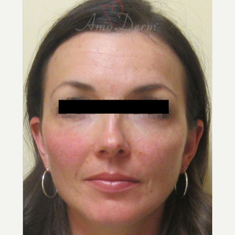 35-44 year old woman treated with Voluma in cheeks after 3222810