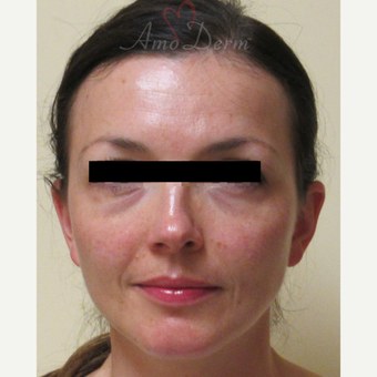 35-44 year old woman treated with Voluma in cheeks before 3222810