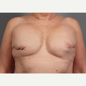 65-74 year old woman treated with Breast Reconstruction Revision before 3371044