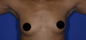 27 yo African American female treated with microlipo of her thighs and fat transfer to her breasts under awake anesthesia before 1130035