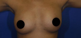 27 yo African American female treated with microlipo of her thighs and fat transfer to her breasts under awake anesthesia after 1130035