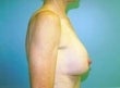 Female patient who underwent a breast lift 926519