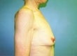 Female patient who underwent a breast lift 926519