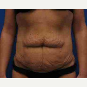 35-44 year old woman treated with Body Lift before 3100150