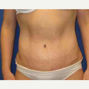 35-44 year old woman treated with Body Lift after 3100150