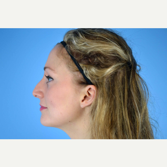 25-34 year old woman treated with Rhinoplasty before 2864128