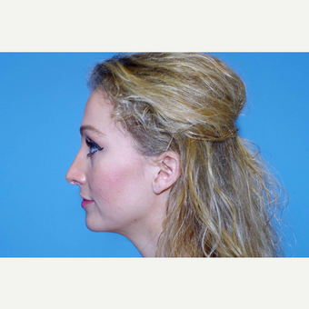 25-34 year old woman treated with Rhinoplasty after 2864128