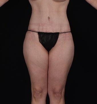 45-54 year old woman treated with SAFELipo after 3126427