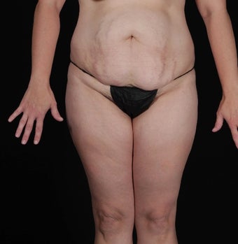 45-54 year old woman treated with SAFELipo before 3126427