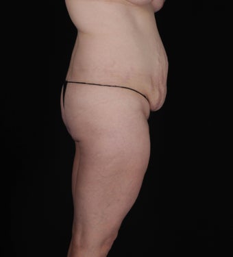 45-54 year old woman treated with SAFELipo 3126427