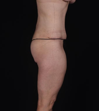 45-54 year old woman treated with SAFELipo 3126427