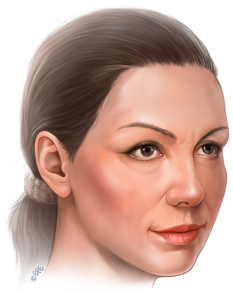 Illustration for Targets of endoscopic mid face lifting after 2843775