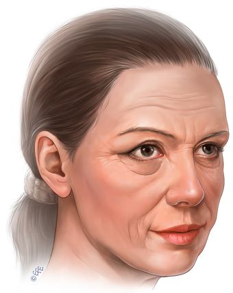 Illustration for Targets of endoscopic mid face lifting before 2843775