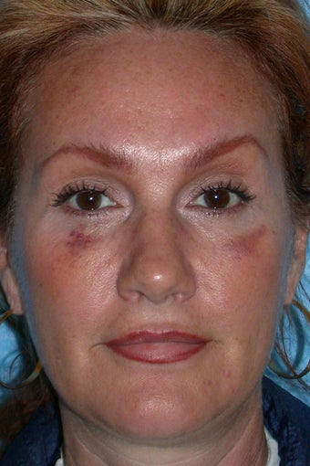 Rhinoplasty before 81112